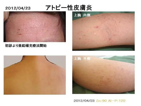アトピー性皮膚炎はこわくない アトピー性皮膚炎はこわくない 三好基晴 - メルカリ