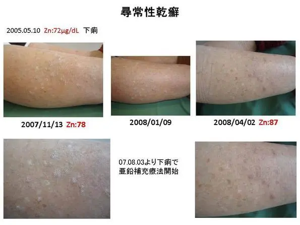 亜鉛欠乏症と皮膚疾患 臨床症例集④ - 東御市民病院・東御市立み
