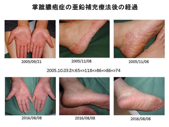 亜鉛欠乏症のその他の症状