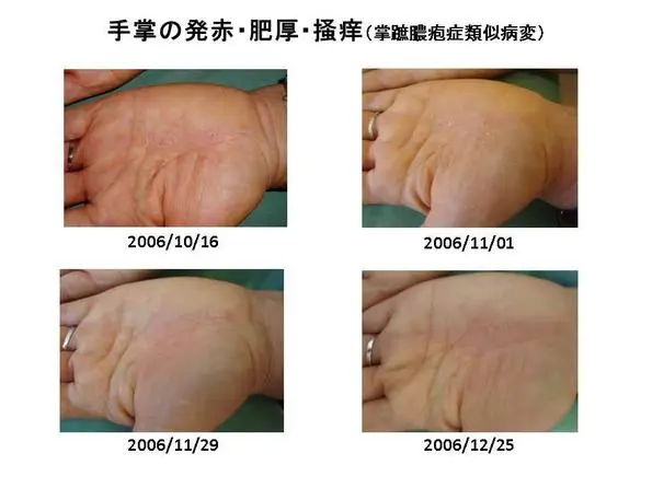 亜鉛欠乏症と皮膚疾患 臨床症例集④ - 東御市民病院・東御市立み