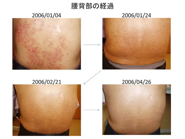 亜鉛欠乏症と皮膚疾患 臨床症例集① - 東御市民病院・東御市立み