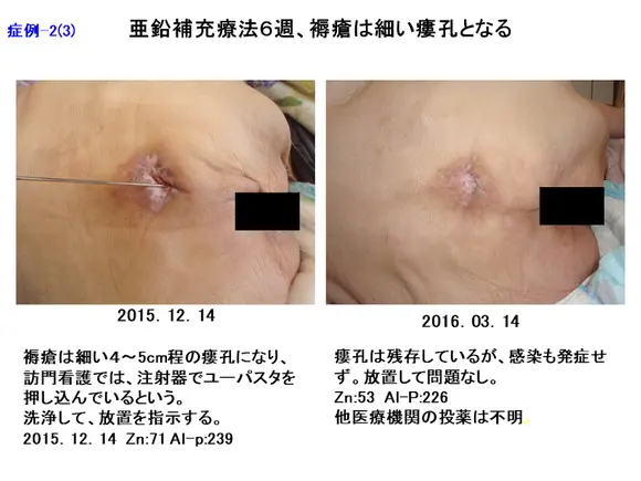 褥瘡のポケット形成について - 東御市民病院・東御市立みまき