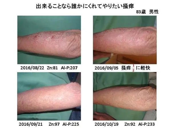 亜鉛欠乏症と皮膚疾患 臨床症例集③ - 東御市民病院・東御市立みまき