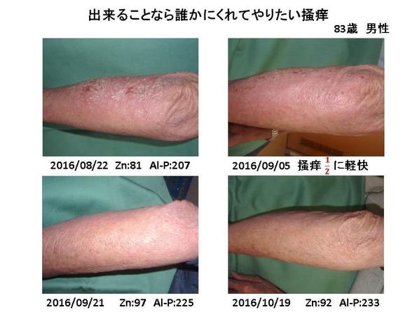 人はどれくらいの亜鉛を必要としますか?